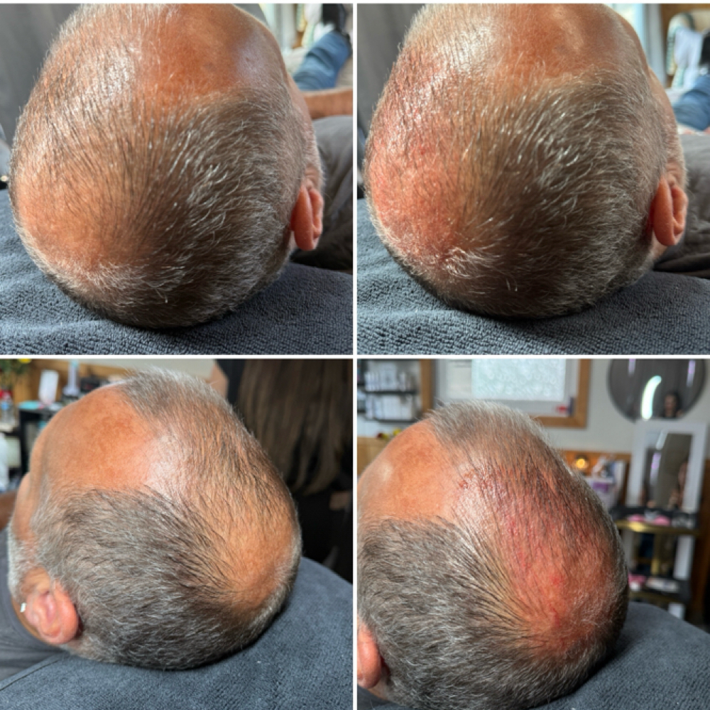 MDPen Scalp/ Hair Renewal at Sacred Lash and Esthetics LLC in Salem, OR