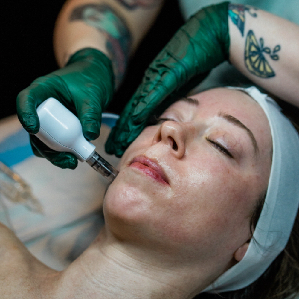 MICRONEEDLING at Eclectic Esthetics in Beech Grove, IN