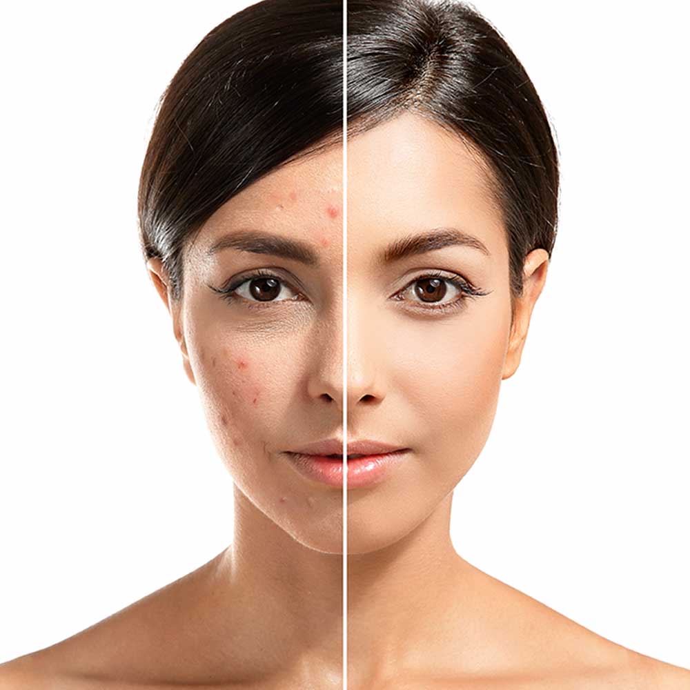 Acne Facial