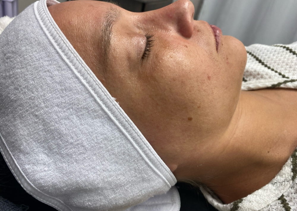 Nanoneedle Facial