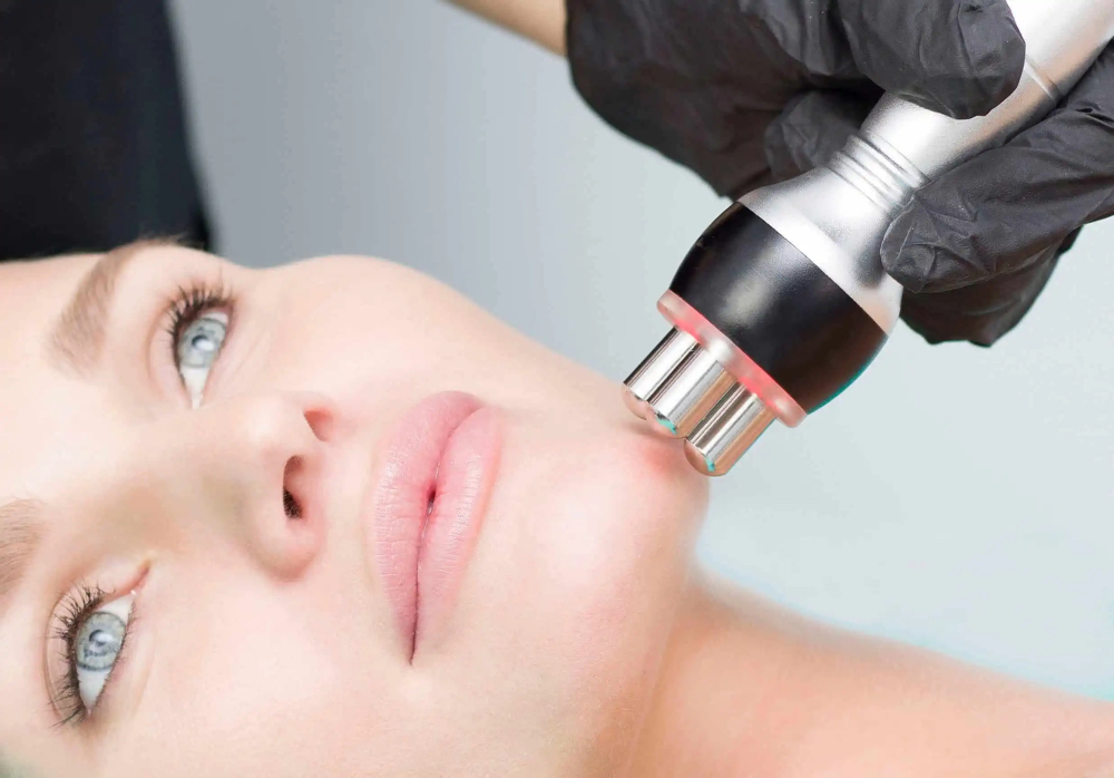 RF Facial at Glam Lab in Rancho Cucamonga, CA