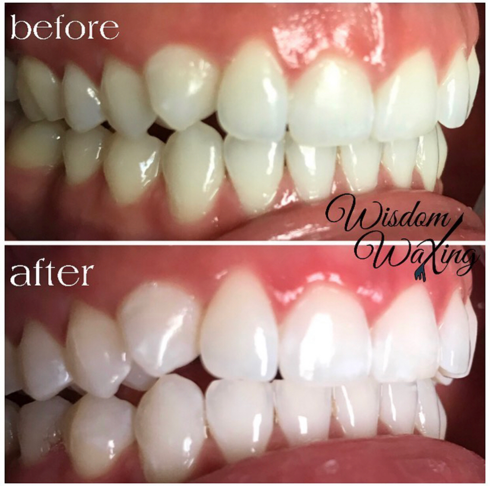 Teeth Whitening