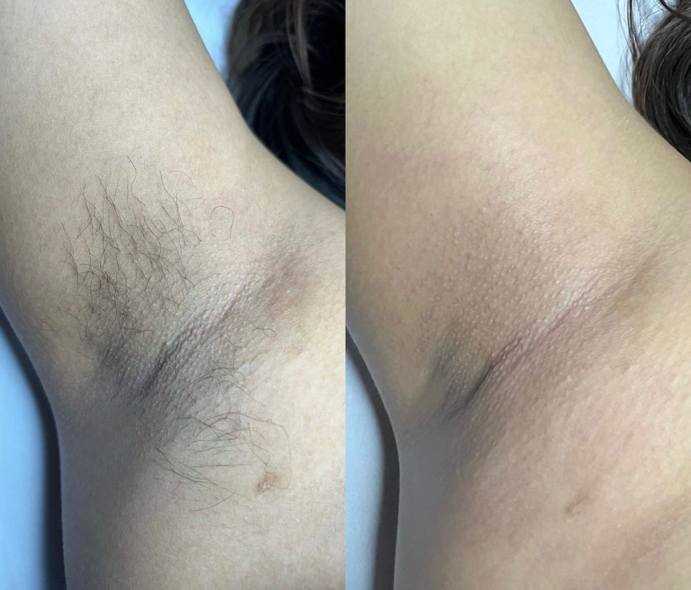 Underarm Wax