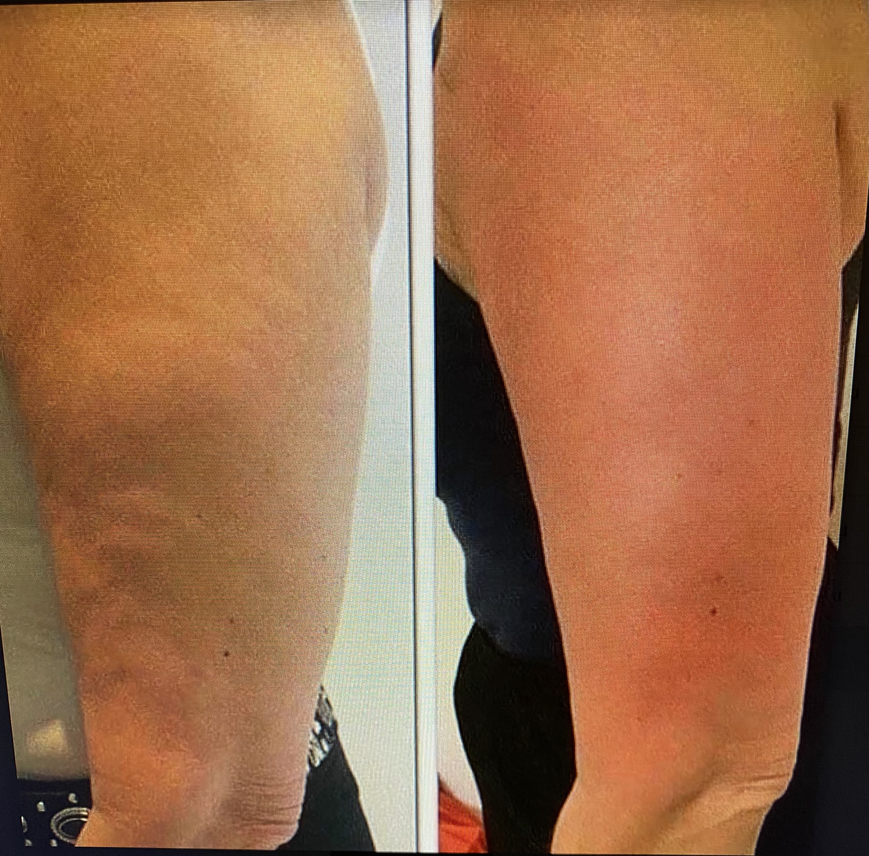 Tissue Stimulation
