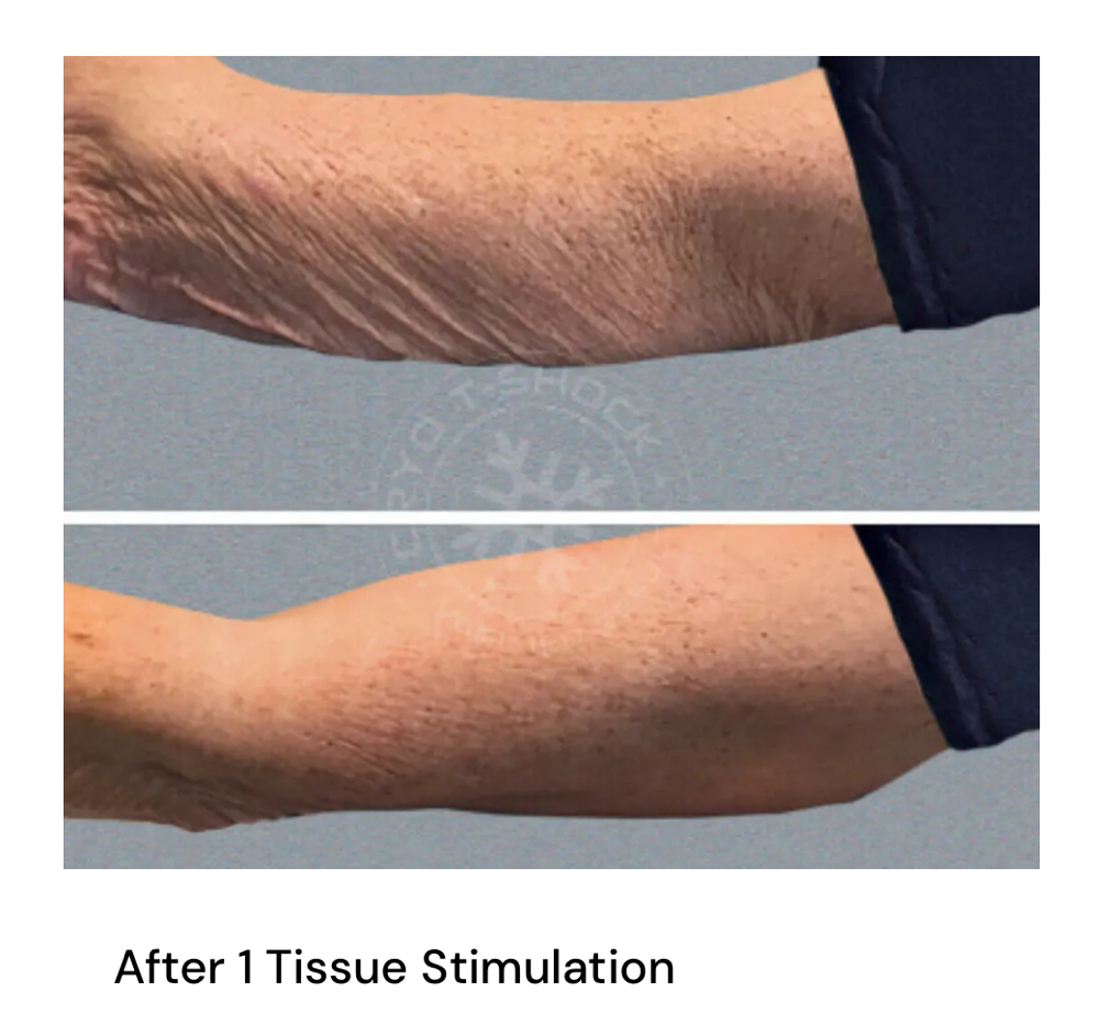 Tissue Stimulation at Lush Cryo and Wellness in Reno, NV