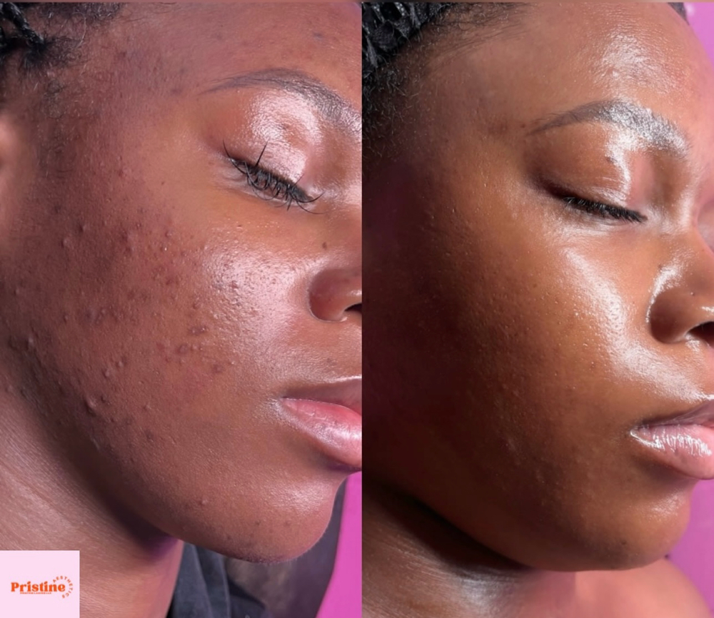 Micro Peels