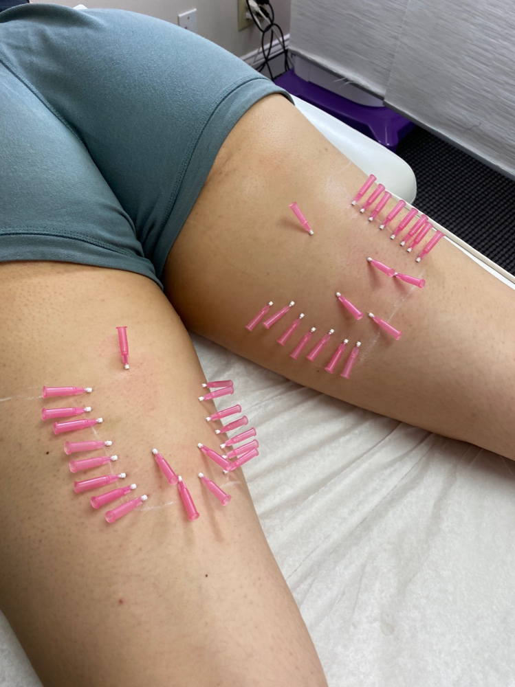 Cellulite & Post-Lipo Dimpling at Aesthetic NP Marie in Portland, OR