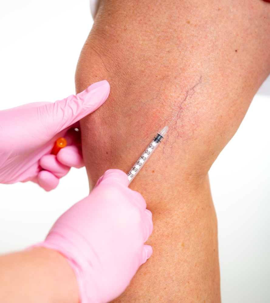 Spider Vein Treatment