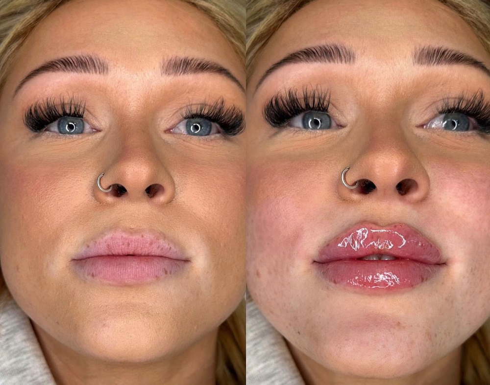 Mini Lip Filler ( half syringe)