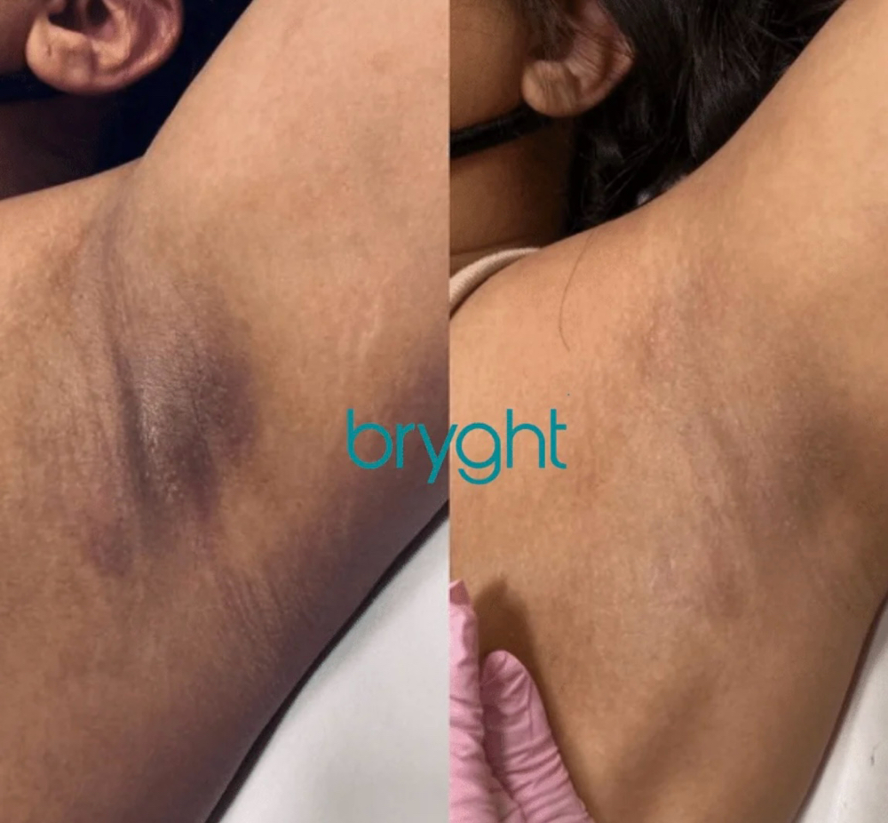 Under Arm Brightening Treatment