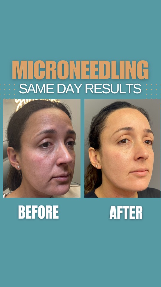 Vampire Microneedling Facial