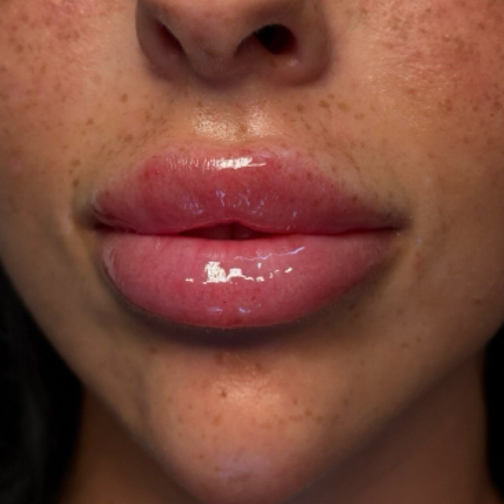 Russian Lips at Eluxy Aesthetics in Arlington, TX