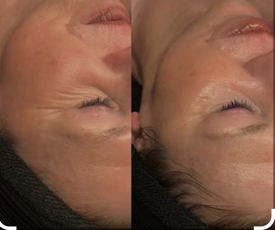 Circadia®️Beyond Botox Facial at Carrie Tattershall in Greenwood, MO