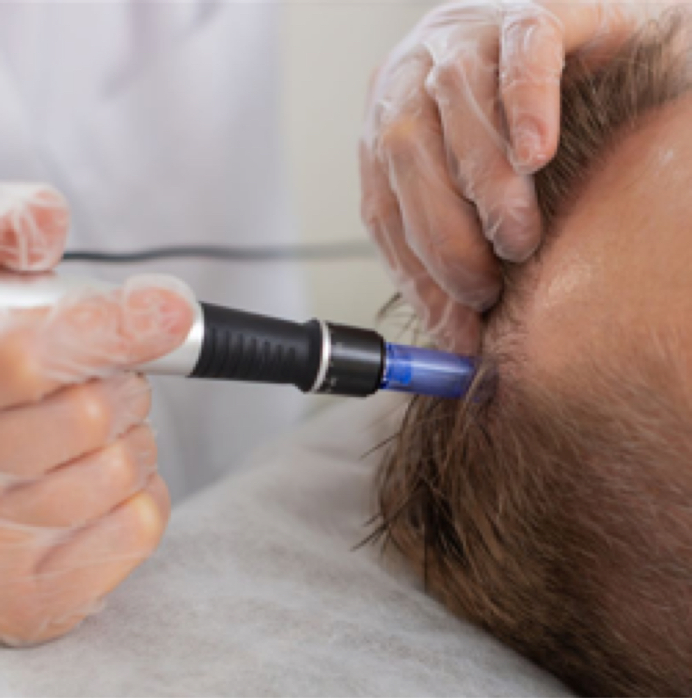 Scalp Microneedling at Blonde Blow Dry & Brow Salon in Yuma, AZ