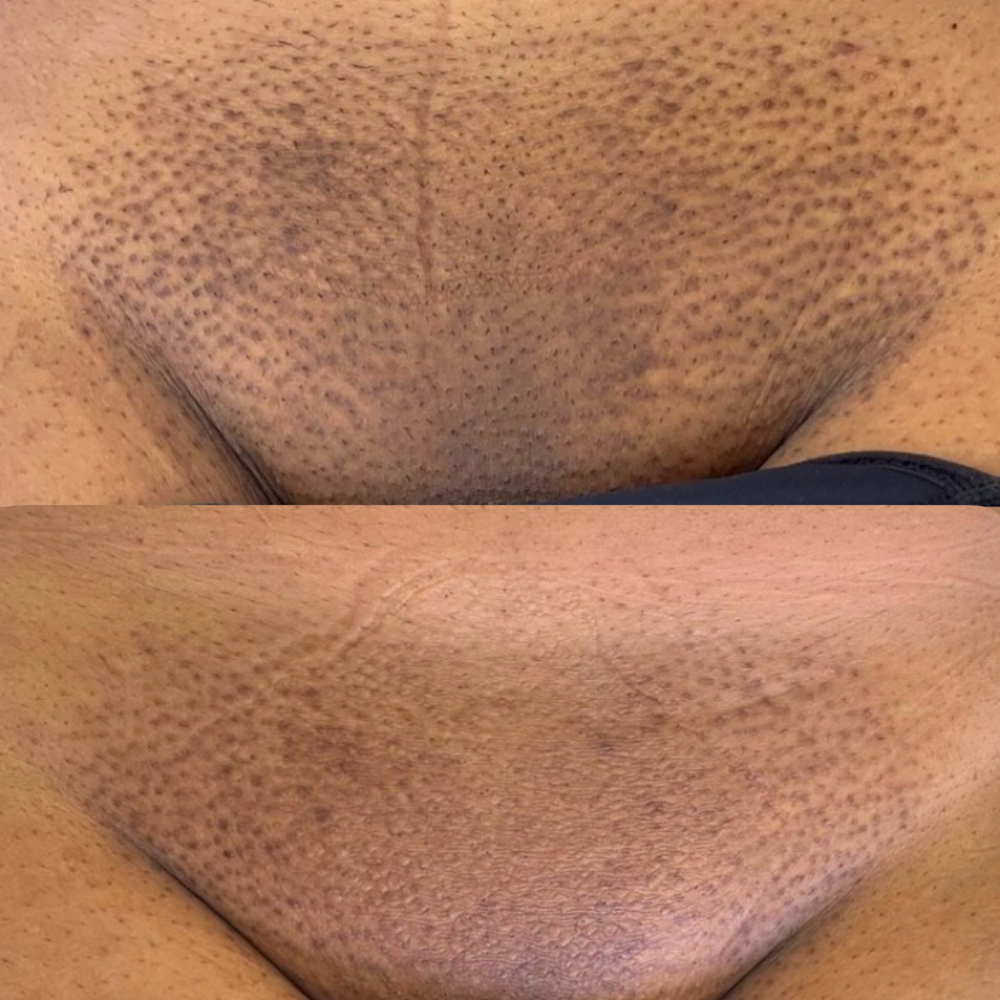 Clareamento Monte Da Pubis at Jessica Luchesi Skin Wellness in Elizabeth, NJ