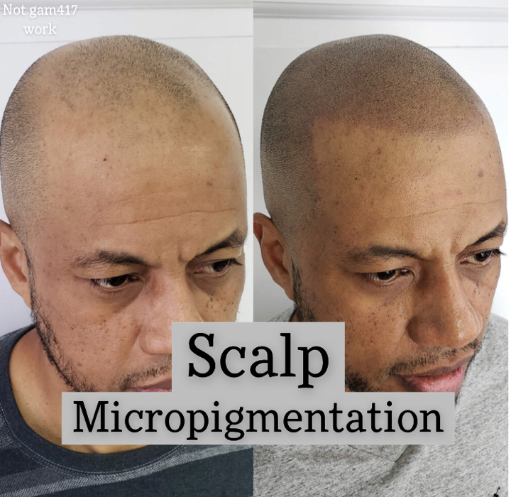 Scalp Micropigmentation