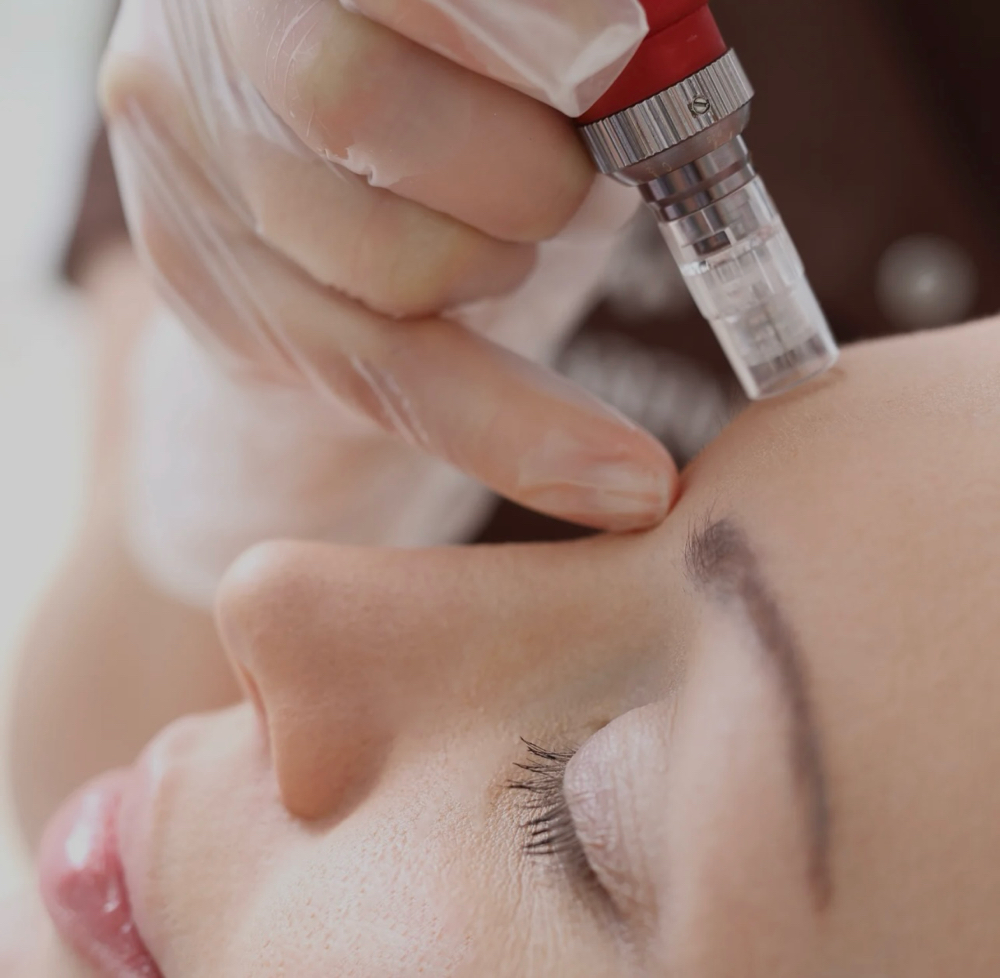 Microneedling