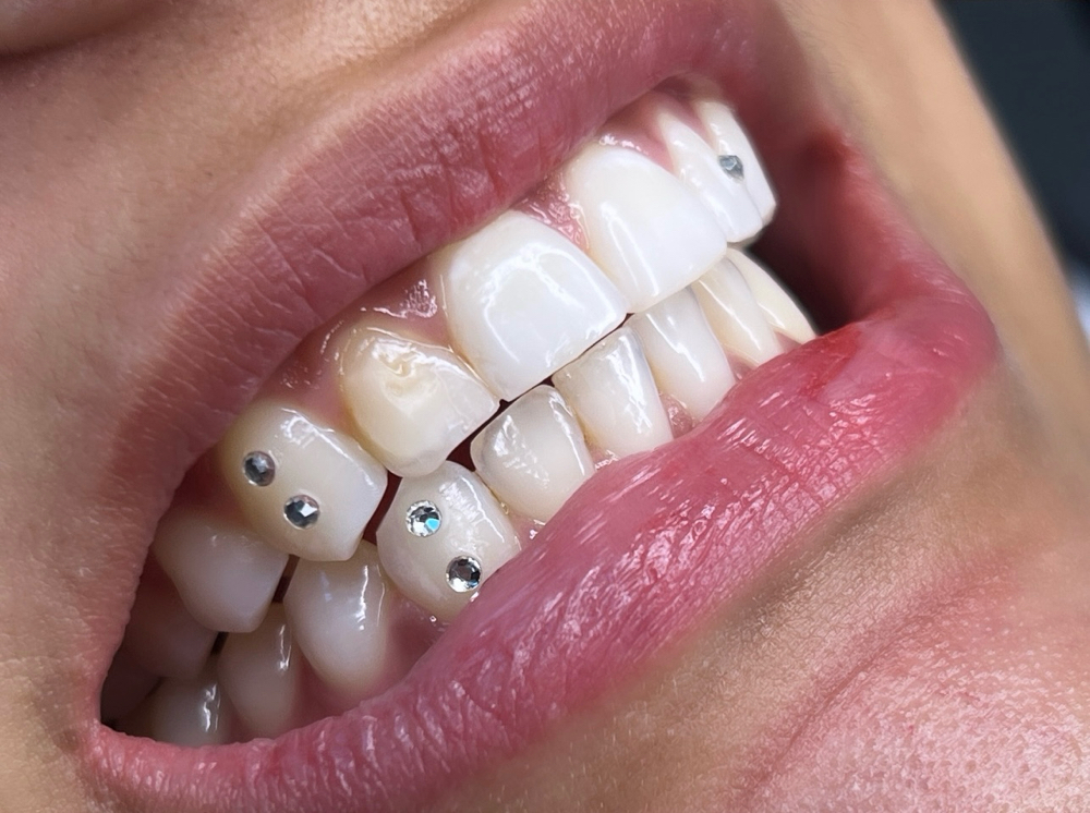 Tooth Gem