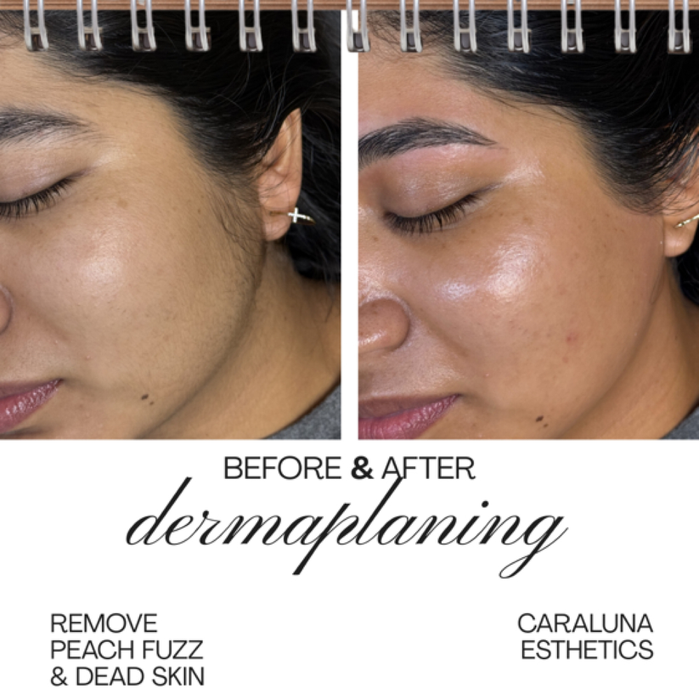 Dermaplaning at Caraluna Esthetics in Baton Rouge, LA
