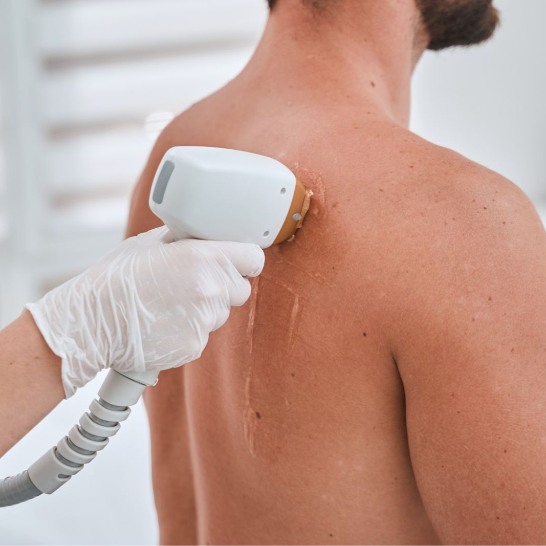 Laser Hair Removal (large area) at Milan Salon Spa in El Paso, TX