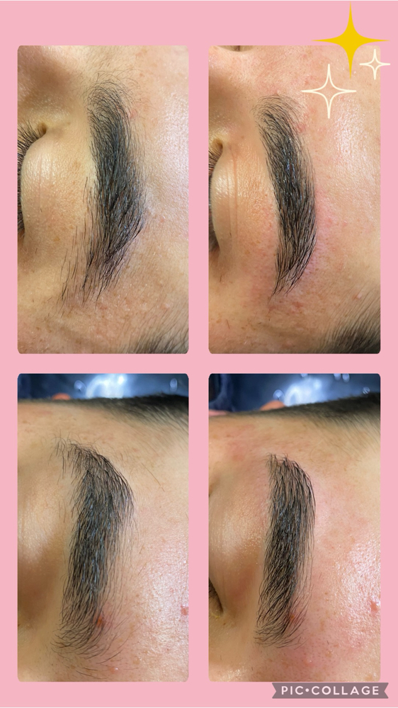 Hair Removal