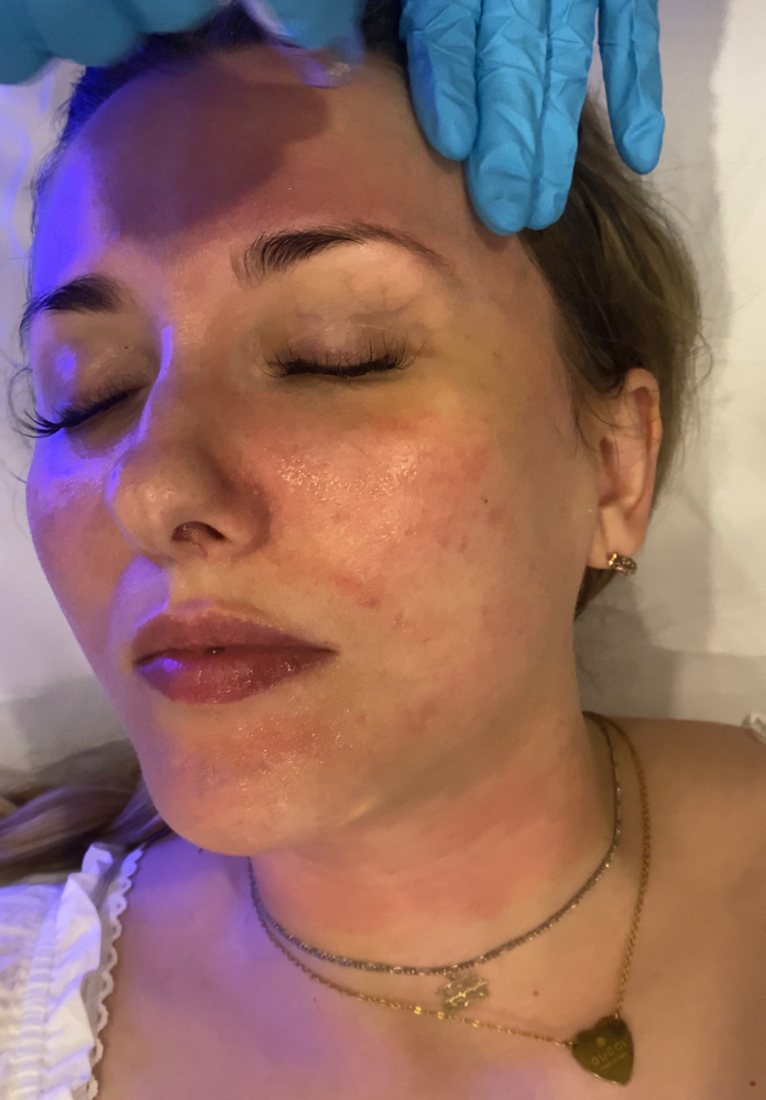 Chemical Peel- Redness + Rosacea