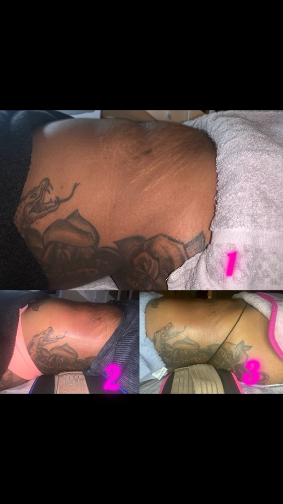 Ultrasonic Cavitation & Laser Lipo