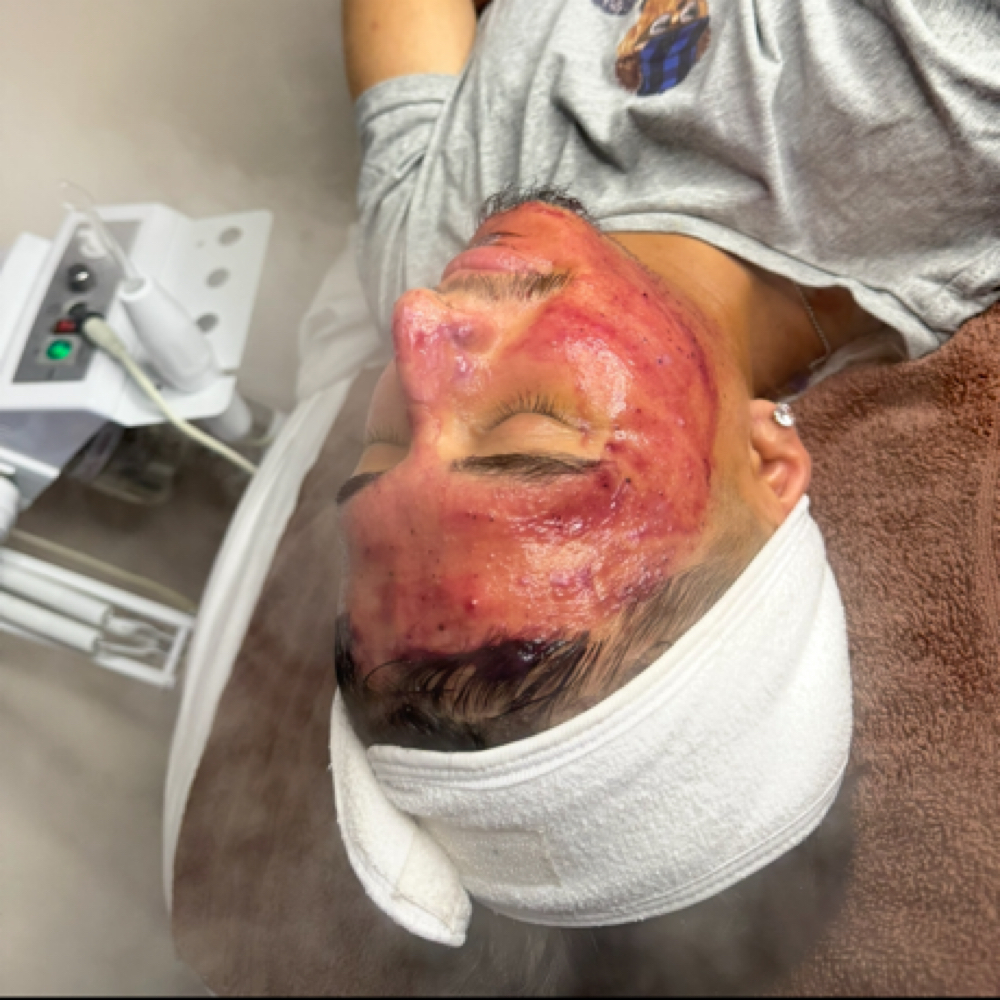 Custom Enzyme Facial at Luminous Complexions Esthetics in Oswego, IL