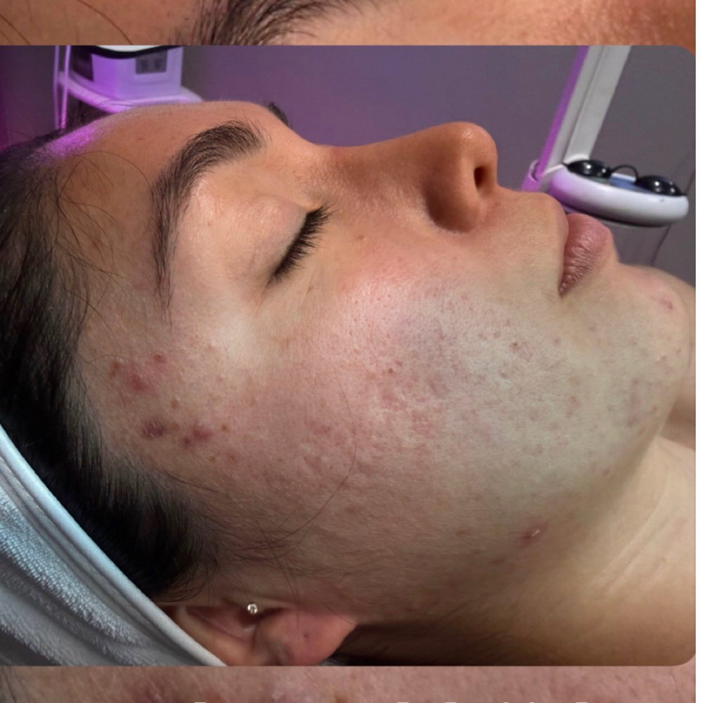 Advanced Acne Treatment Package 7 at It’s Your Beauty Time in Downey, CA