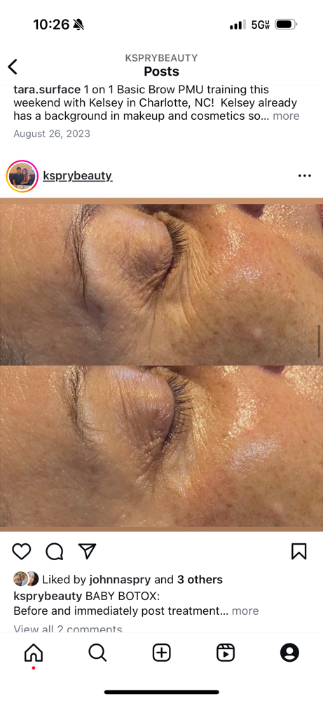 Baby Botox Facial