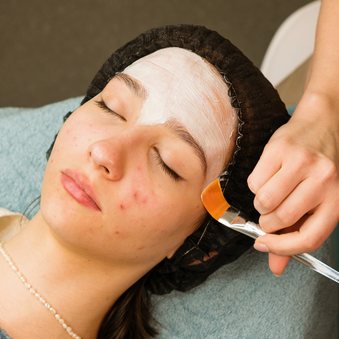 Teen Acne Be Gone Hydrafacial