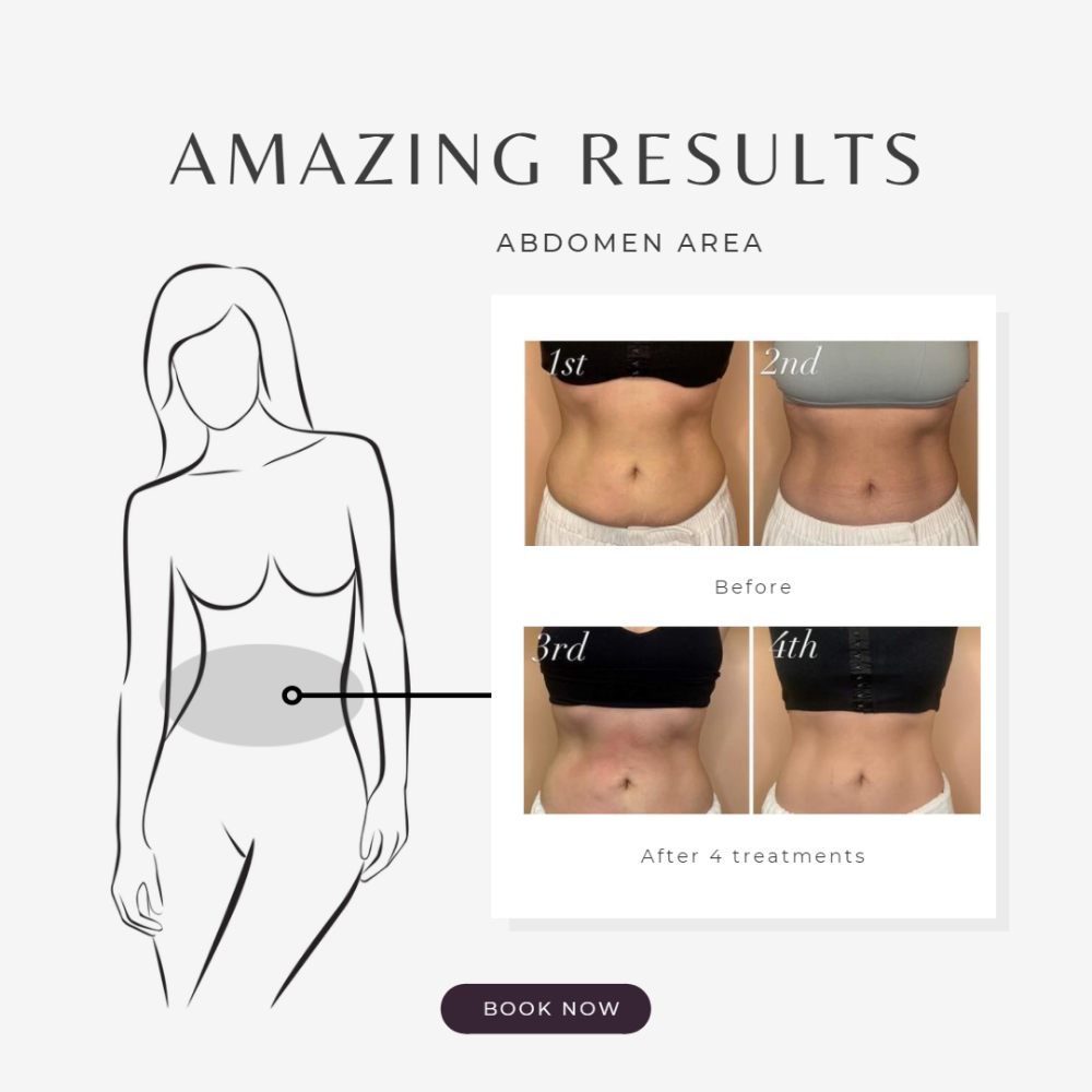 Body Contouring Pkg 10