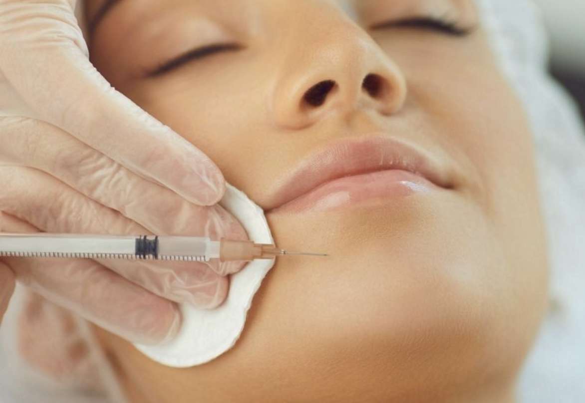 Dermal Filler Labial Mental Groove