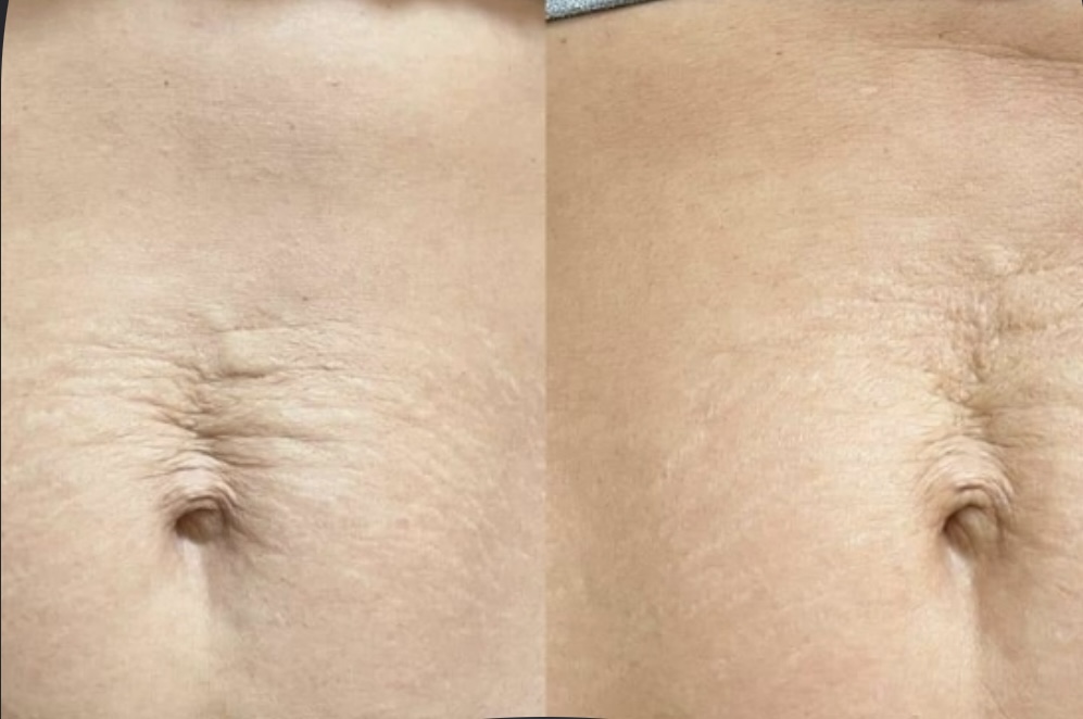 Microchabelling Body Stretch Marks