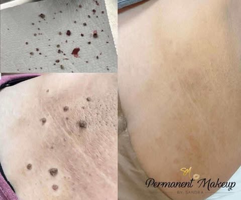 Skin Tag/Miia/Wart/Angioma Removal at Peridot Studio in Lubbock, TX