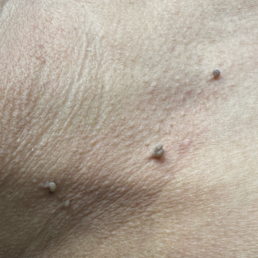 Skin Tag Removal (Up To 15) at Peridot Studio in Lubbock, TX