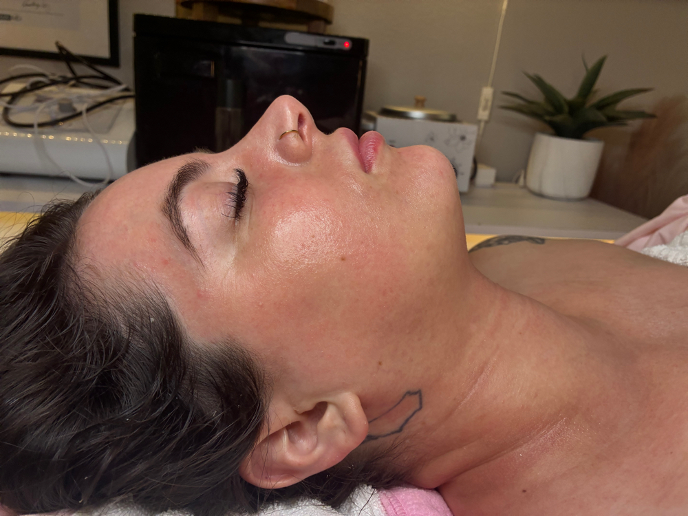 RF Microneedling