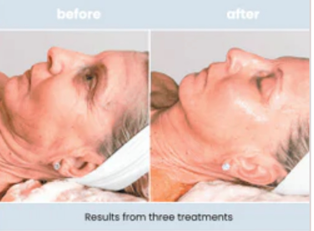 Circadia’s SWiCH Treatment