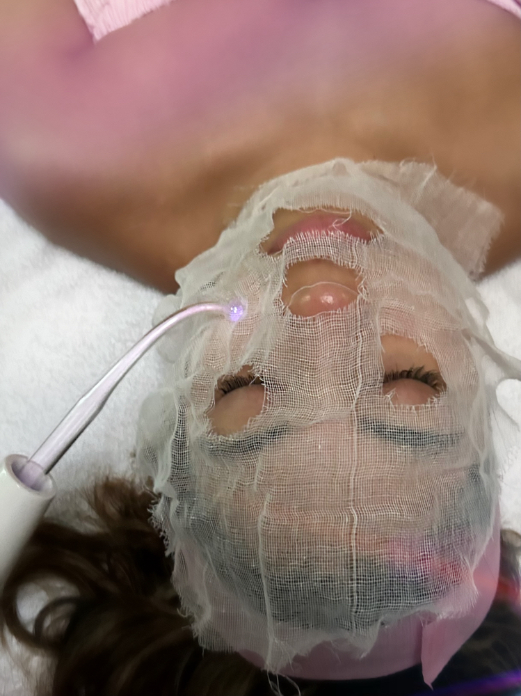 Microdermabrasion