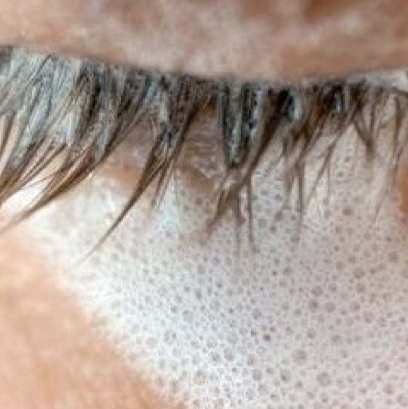 Lash Removal