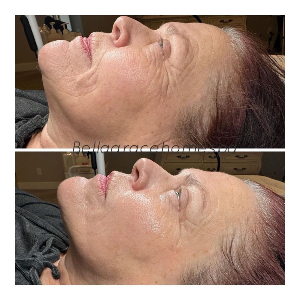 HOP + Pilleo Mask Treatment Non Injectable Facial Filler