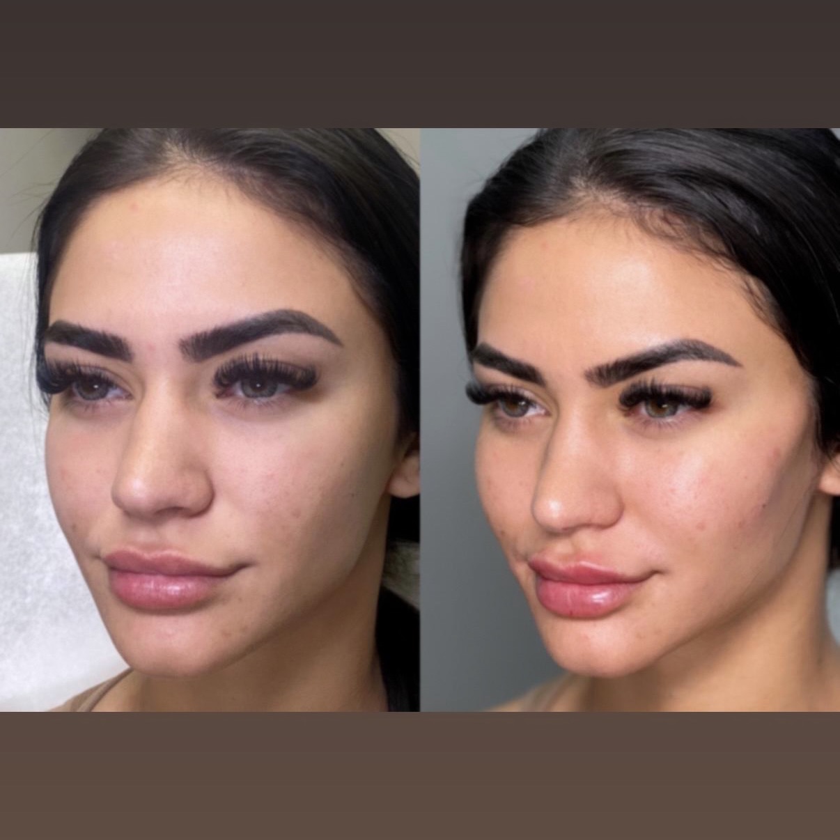 Filler Cheeks at Gold Stone Beauty in mcallen, TX