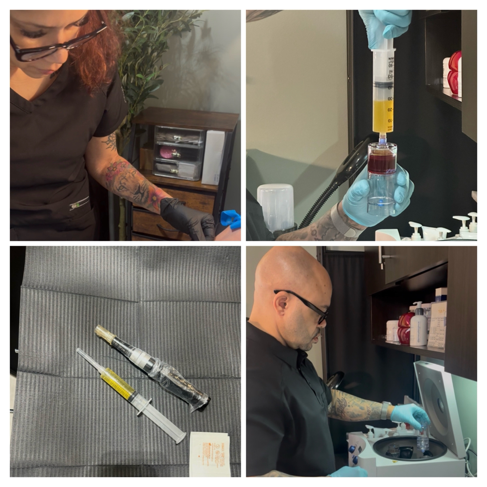 Microneedling PRP Facial at T&N Skin Med Spa Inc in Abington, PA