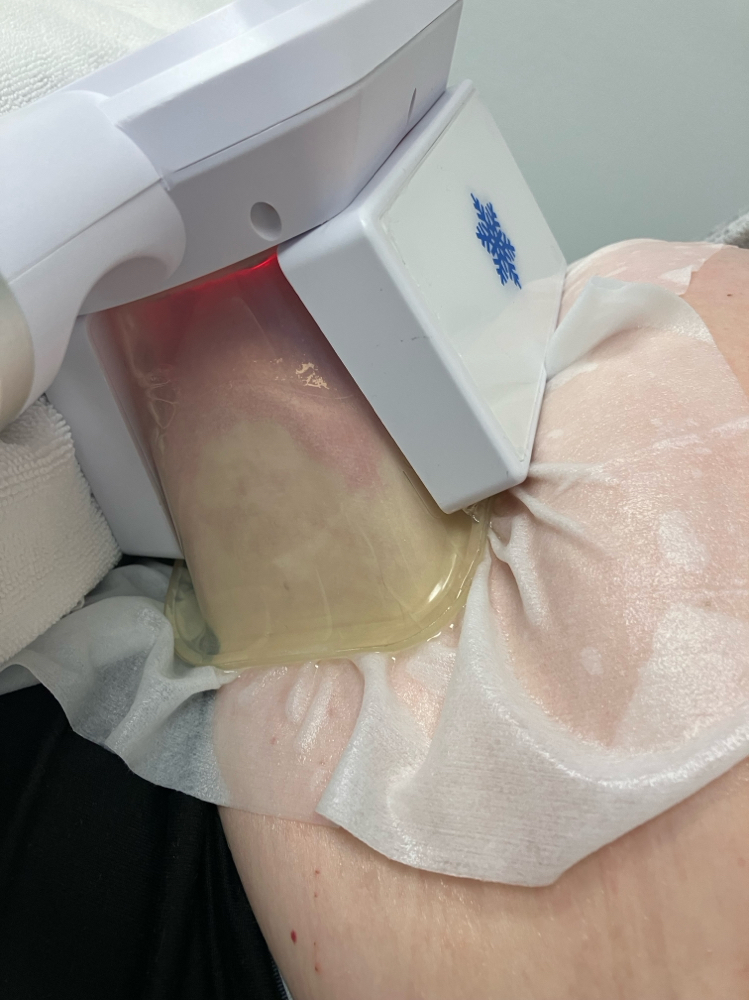 Cryolipolysis