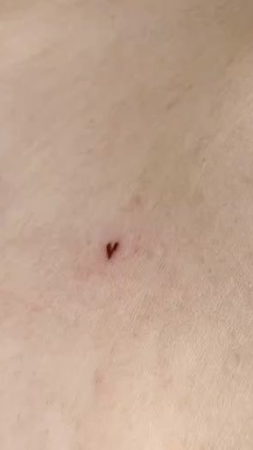 Red Patch Test