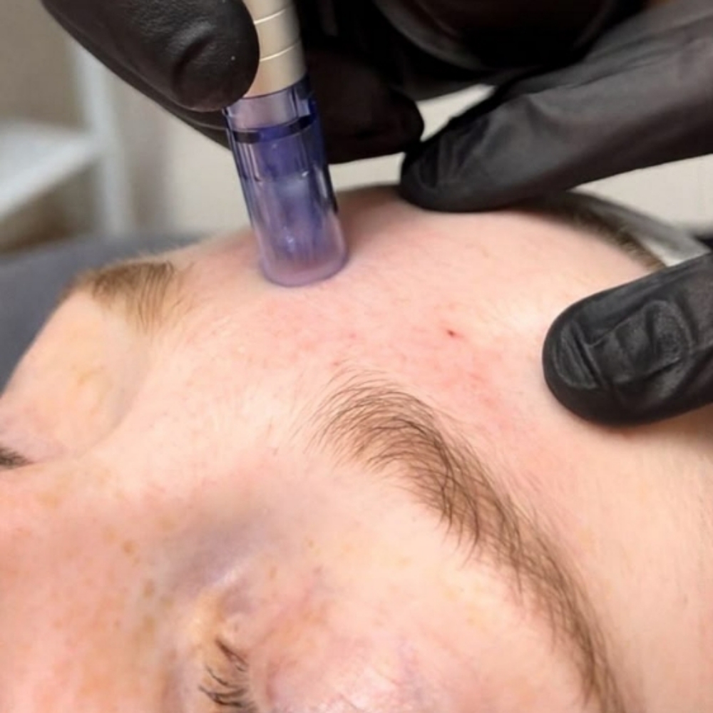 Microneedling at Moore Realistic in Houston, TX