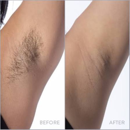 Under Arm Laser Hair Removal at The Beautee Spot in Phoenix, AZ