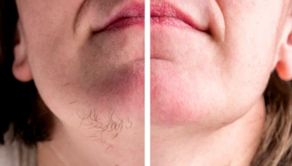 Chin Wax