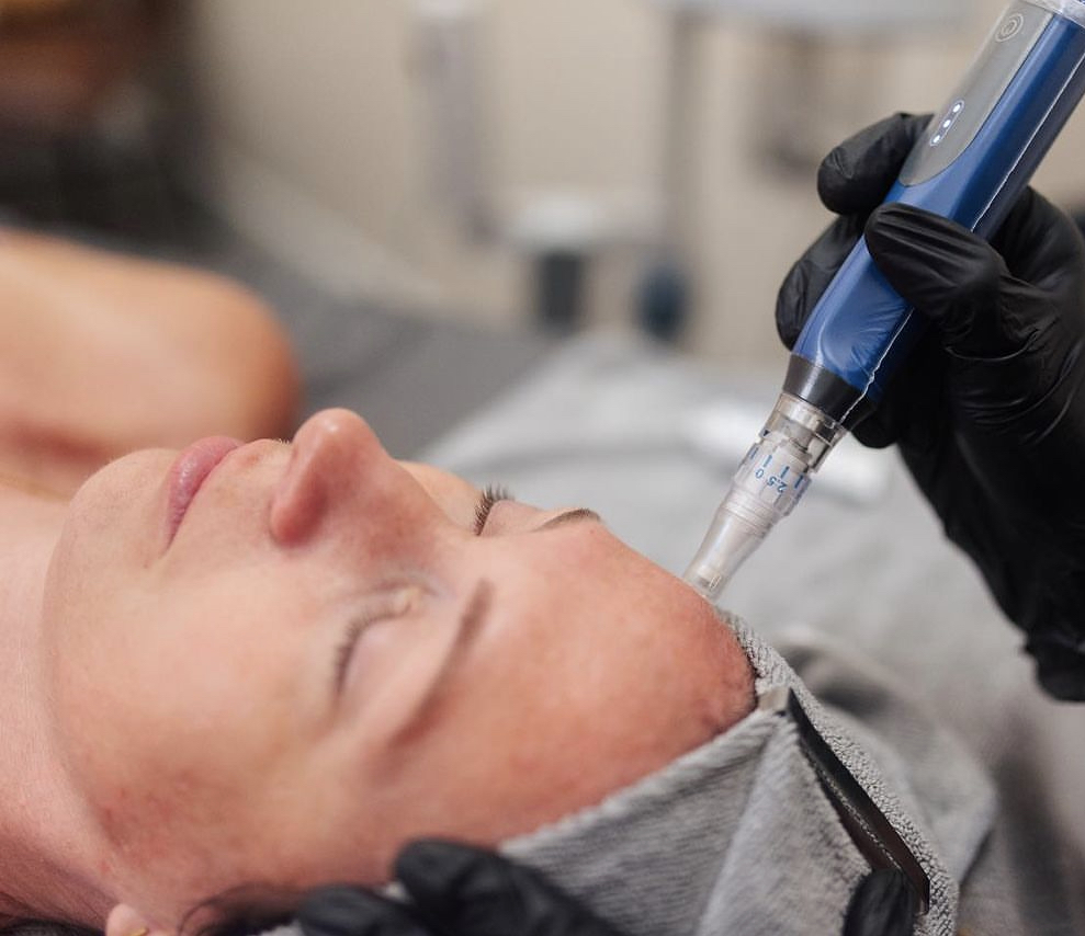 Microneedling (Face)