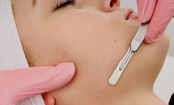 Dermaplane Procedure